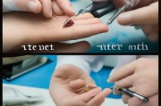 尖锐疣的治疗方法与注意事项